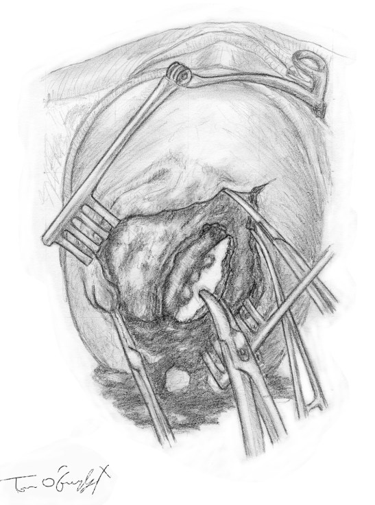 fracture crane embarrure extraction