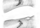 plaie cutanee superficielle suture