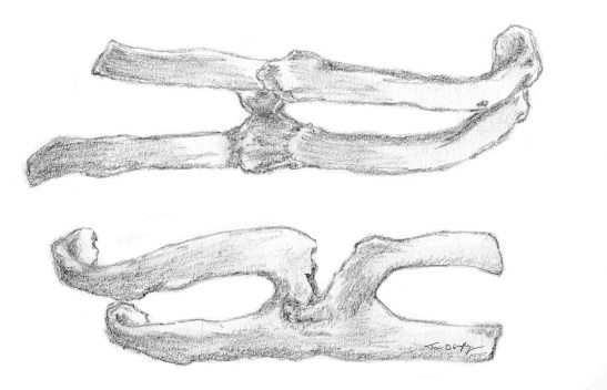 cotes cal vicieux sequelle fracture