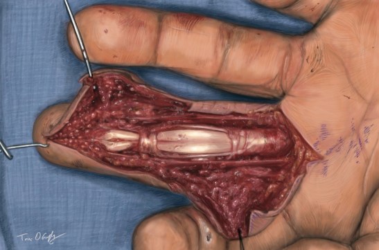 débridement chirurgical d'un doigt après injection à haute pression