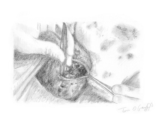 debridement gangrene Fournier 1