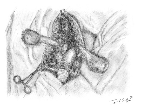 debridement gangrene Fournier 2