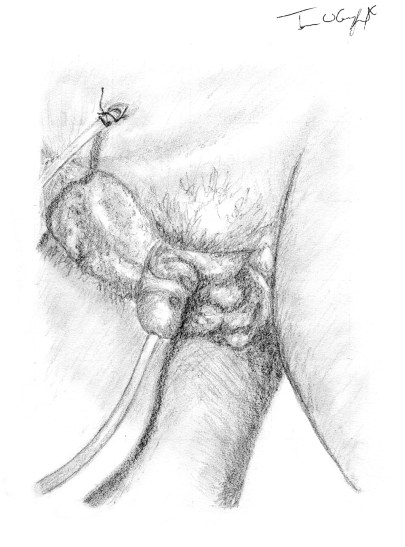 debridement gangrene Fournier 3