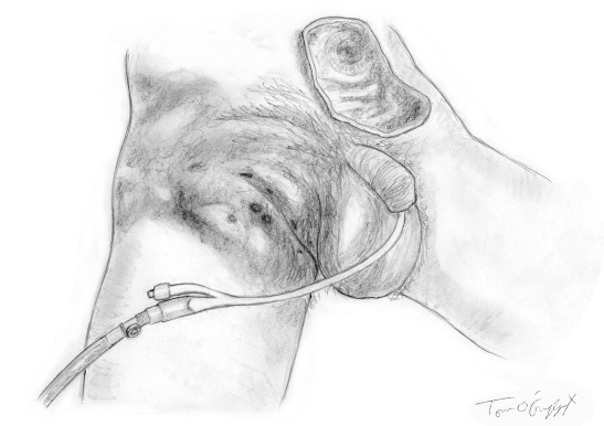 gangrene perineale Fournier