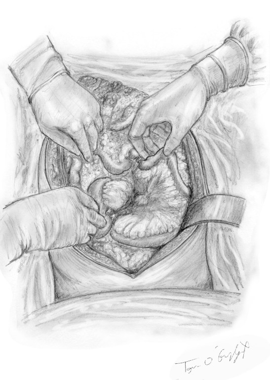 laparotomie damage control