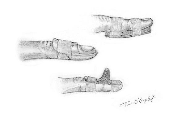 mallet finger attelles