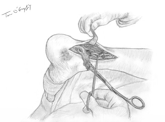 rupture tendon Achille suture