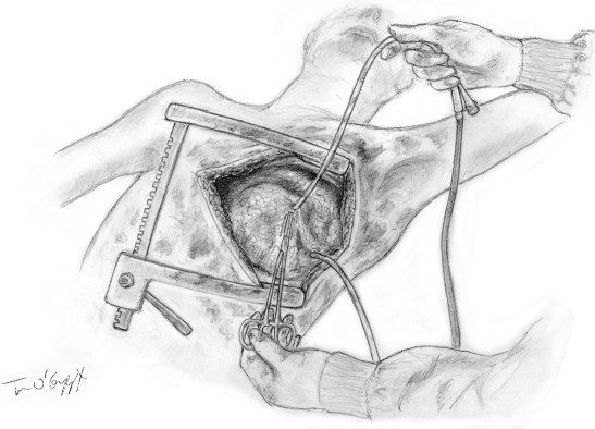 thoracotomie laterale hemostase compression foley