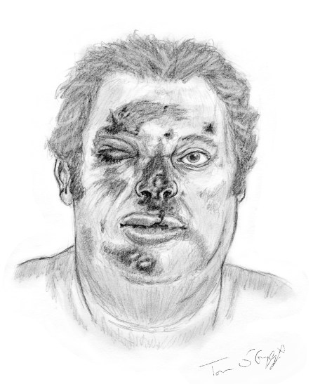 dermabrasion faciale grave