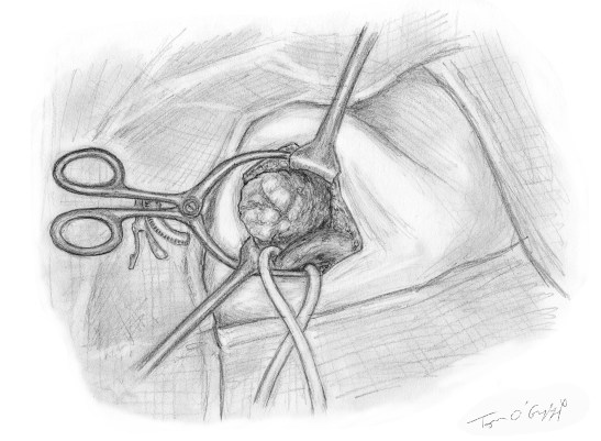 hernie inguinale cure