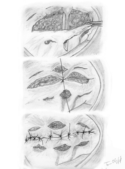 incisions de decharge cutanee