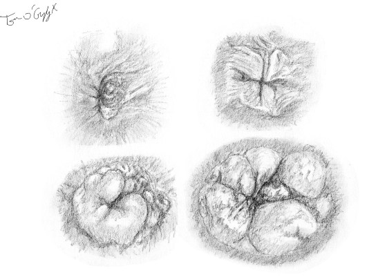 thrombose hemorroides marisques