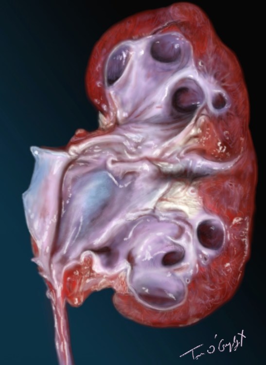 colique nephretique hydronephrose