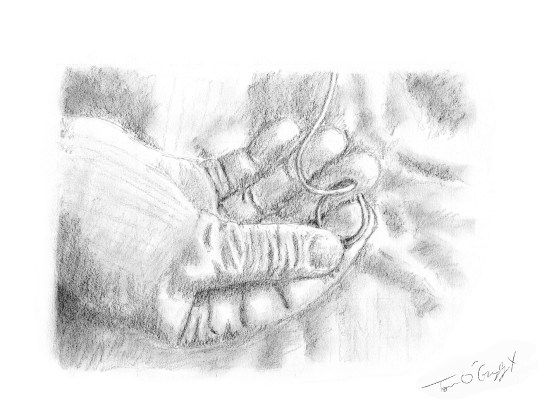 colique nephretique sonde JJ