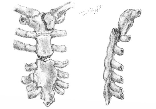 fracture sternum