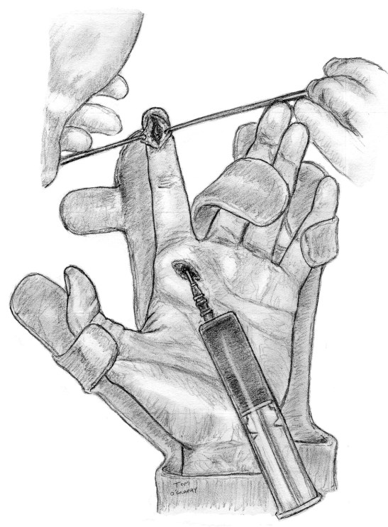 lavage phlegmon gaine synoviale tendon flechisseur