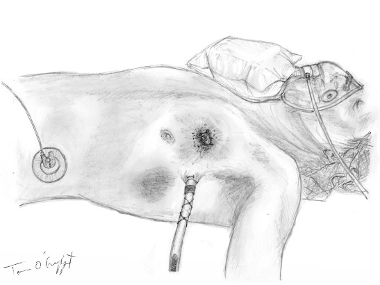 traumatologie thorax drain