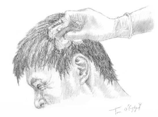 plaie scalp compression