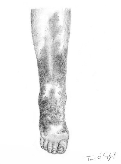 erysipele membre inferieur