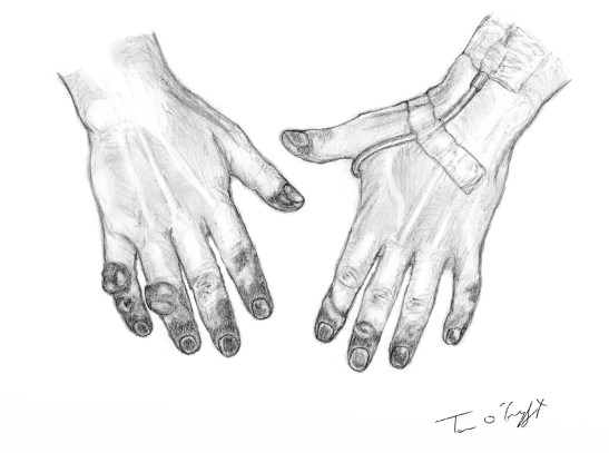 gelures mains doigts