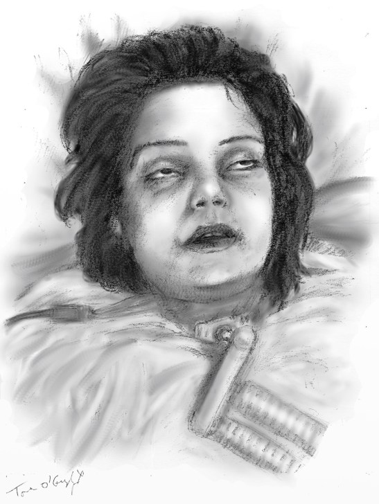 botulisme tacheotomie