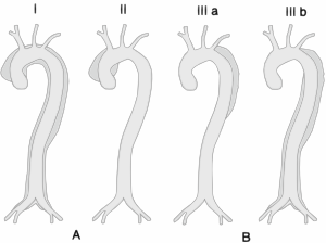 classification dissections aorte