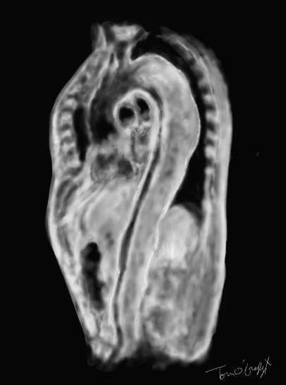 dissection aortique scanner