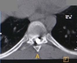 scanner plaie par balle vertebrale