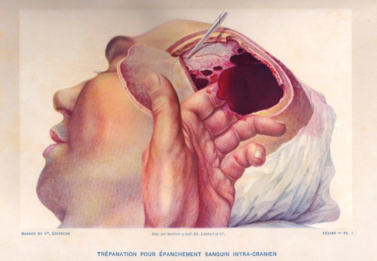 Lejars trépanation hématome extra-dural
