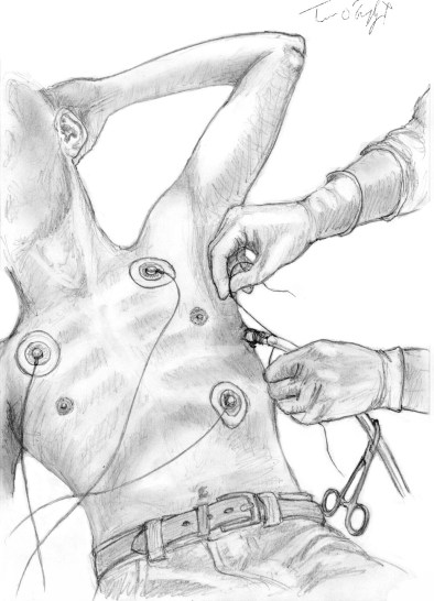 drain thoracique ligne axillaire moyenne