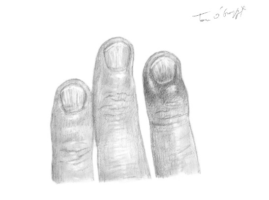 fracture doigt troisieme phalange