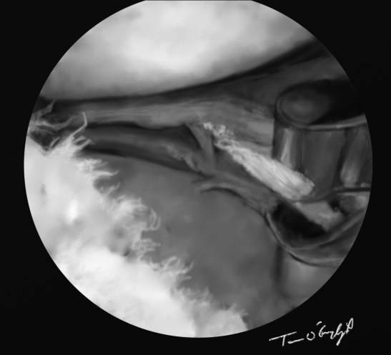 genou arthroscopie menisque ciseau shaver