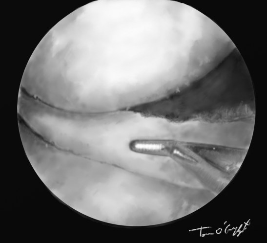 genou arthroscopie menisque crochet