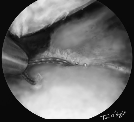 genou arthroscopie menisque suture