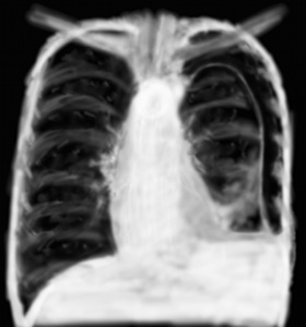 Interprétation d’une radiographie thoracique en urgence – 2 – la plèvre ...