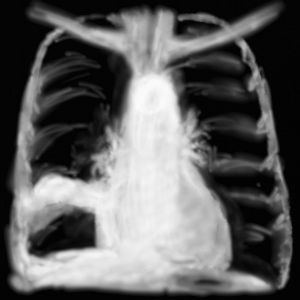 Interprétation d’une radiographie thoracique en urgence – 4 – opacité ...