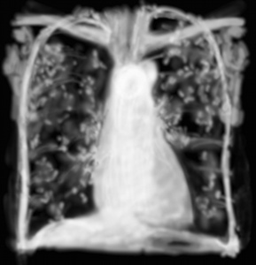 RP pneumopathie d'hypersensibilité