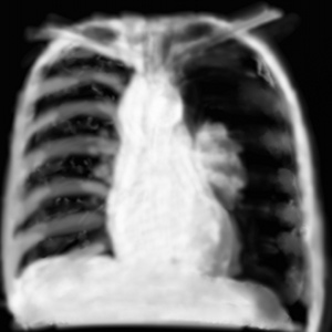 pneumothorax complet