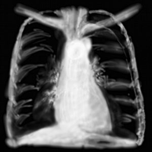 RP pneumothorax modéré