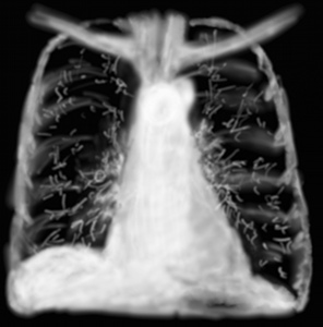 RP lymphangite carcinomateuse