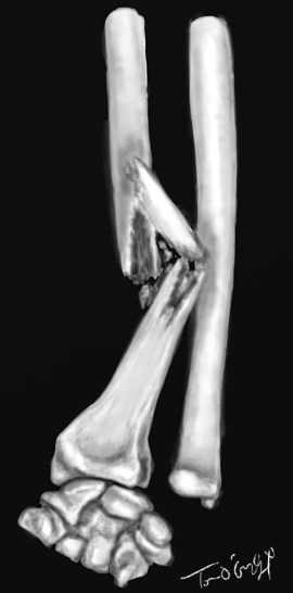 fracture de Galeazzi