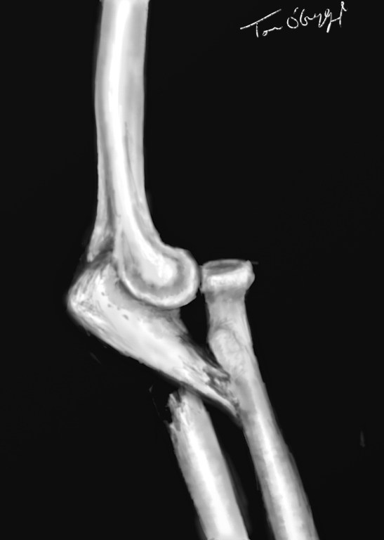 fracture de Monteggia