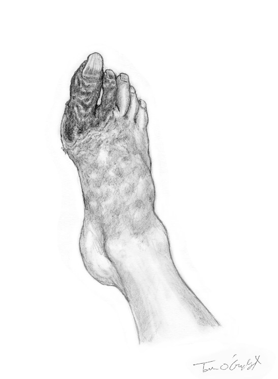 ischemie membre inferieur necrose gangrene seche