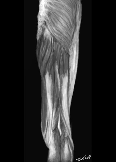 rhabdomyolyse muscles membre inferieur
