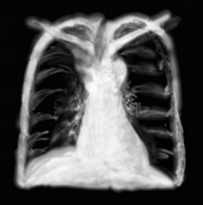 RP atélectasie lobe supérieur droit