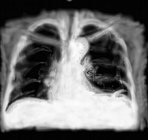 RP atélectasie plane