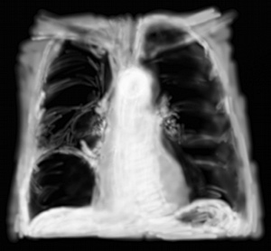 RP bulle d'emphysème