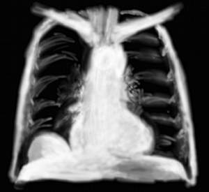 RP éventration diaphragmatique