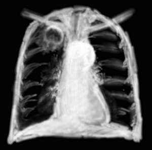 RP caverne tuberculeuse