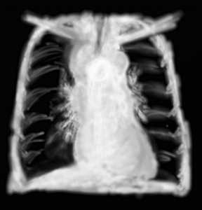 RP maladie de Hodgkin